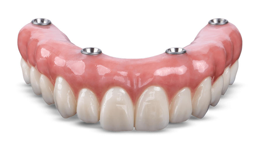 Implant Retained Overdenture or Denture