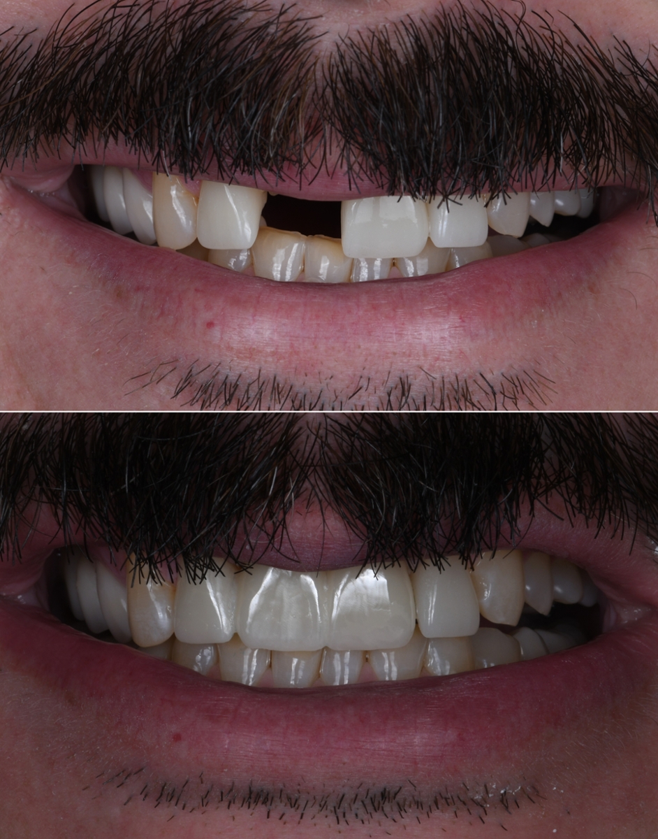 Before and after smile transformation showing a gap between front teeth corrected with natural-looking crowns.