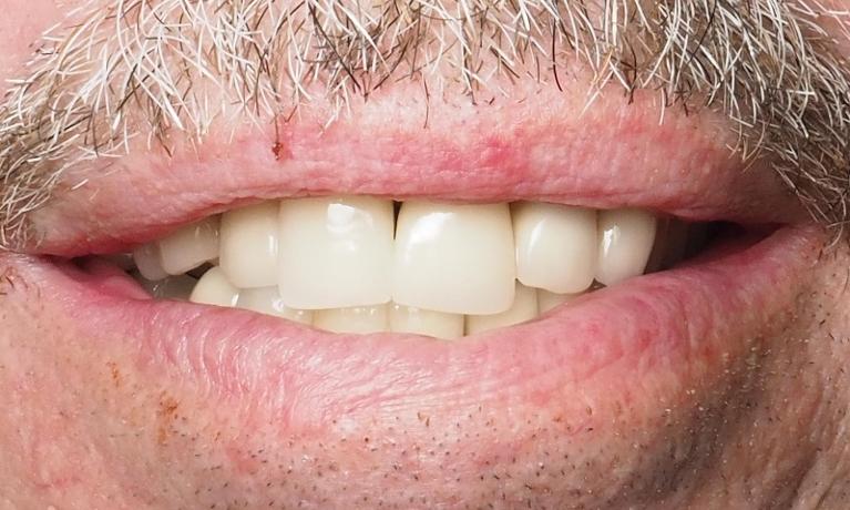 After dental implant to replace front tooth in Winston Salem