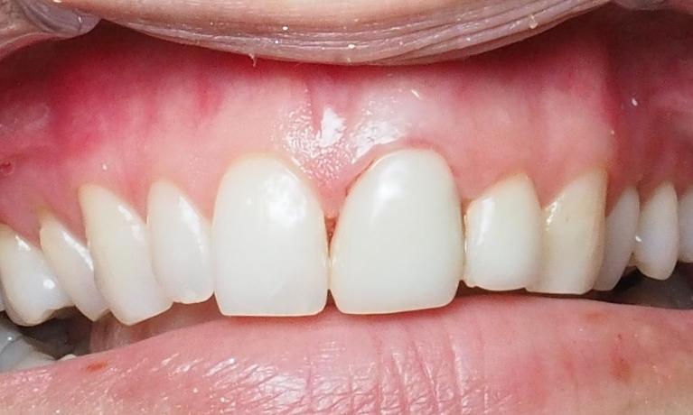 After esthetic dental crown to correct a stained margin | winston salem dentist
