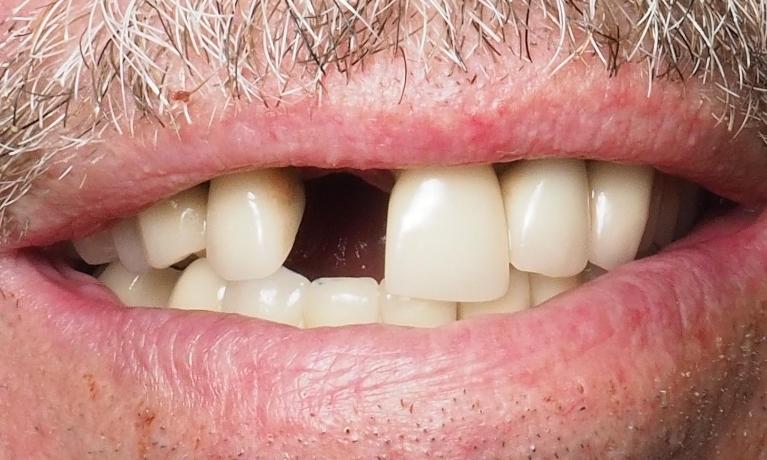 Before dental implant procedure in Winston Salem