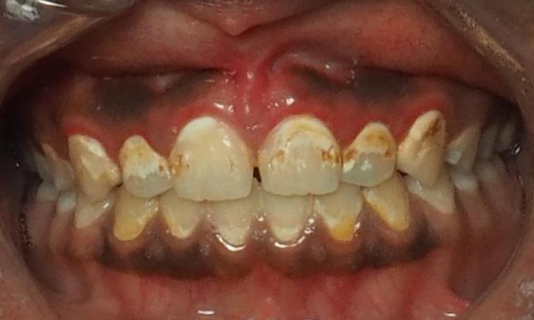 Before composite veneers in Winston Salem | dentist winston salem nc