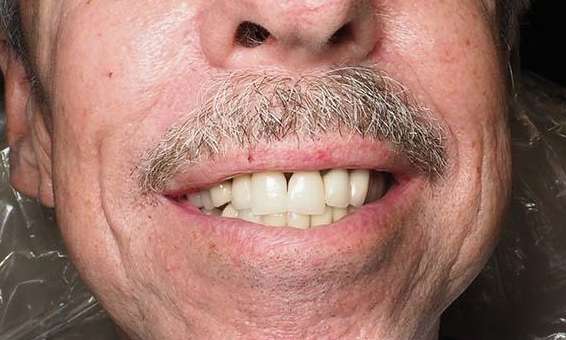 Close up of white mans mouth after Winston-Salem implants