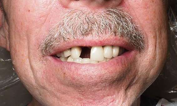 Close up of white mans mouth before implants in Winston Salem