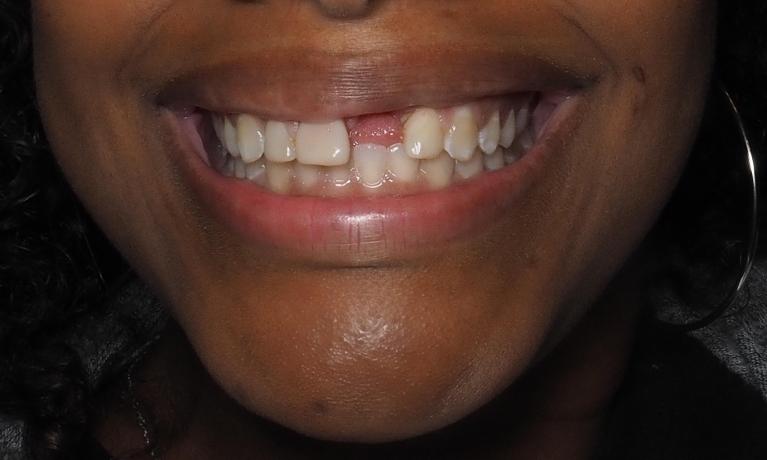 Before picture of front tooth dental implants, winston salem nc